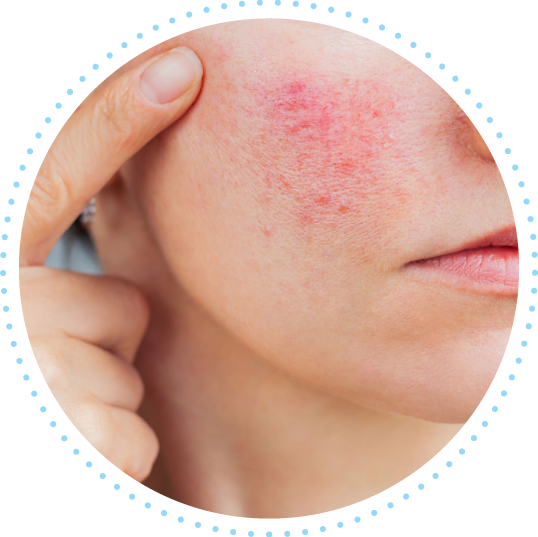 赤ら顔・酒さ・ニキビのハーブピーリングイメージ