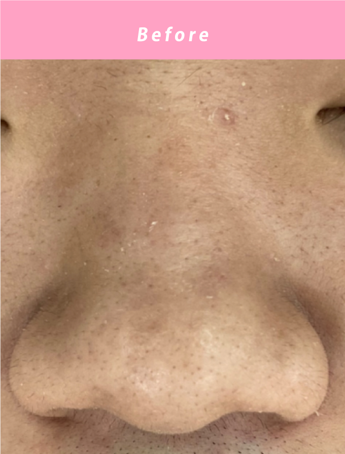 毛穴洗浄ビフォー